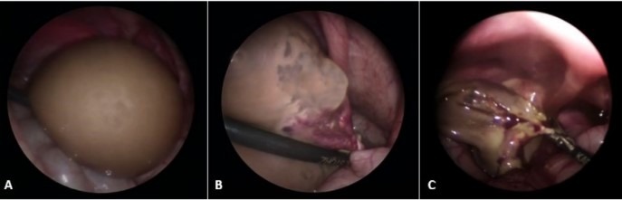 عکس کیست تخمدان
