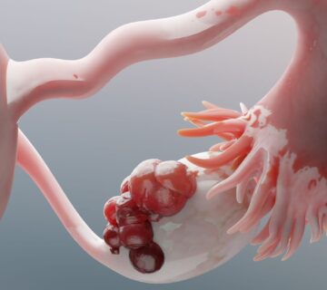 کیست تخمدان