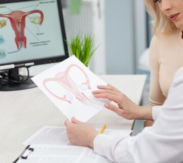 کیست درموئید تخمدان