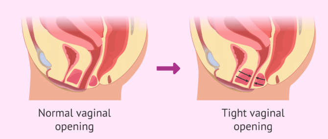 عکس واژینیسموس
